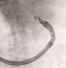 Accesso ecoendoguidato nella via biliare principale